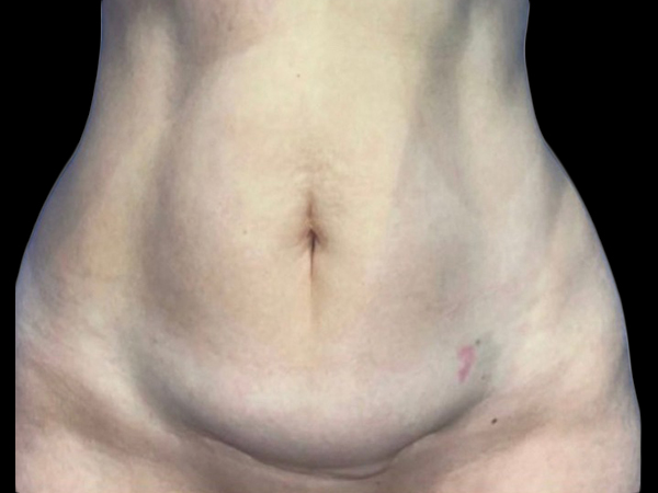 Tummy Tuck Before and After 4a
