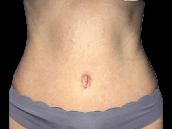 Tummy Tuck Before and After 4b