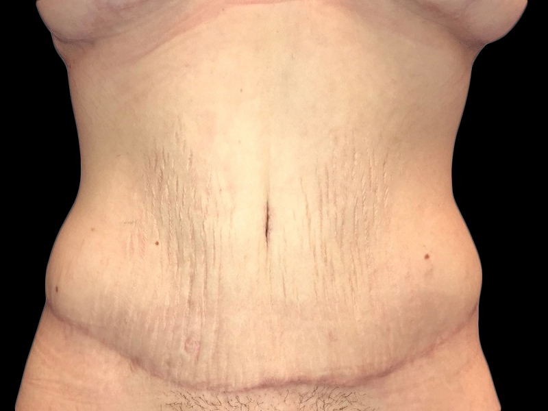 Case--21268 | After Tummy Tuck