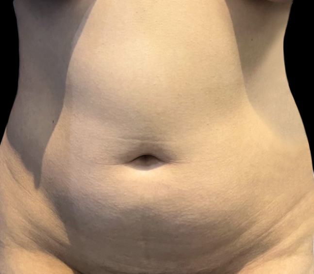 Case--21273 | Before Liposuction