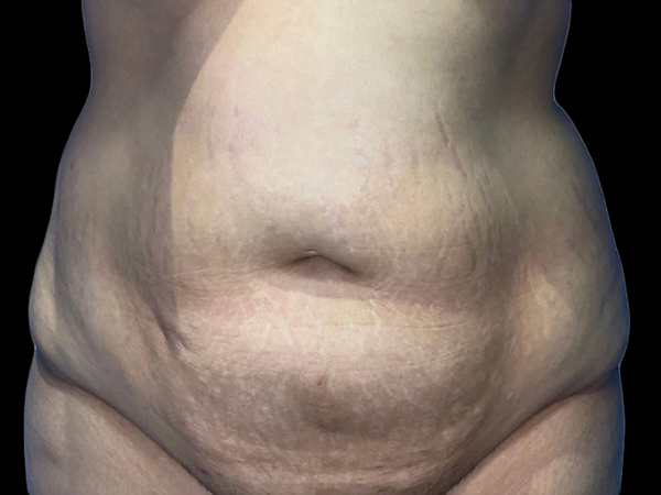 Case--21278 | Before Tummy Tuck