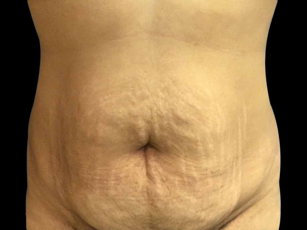 Case--21243 | Before Tummy Tuck