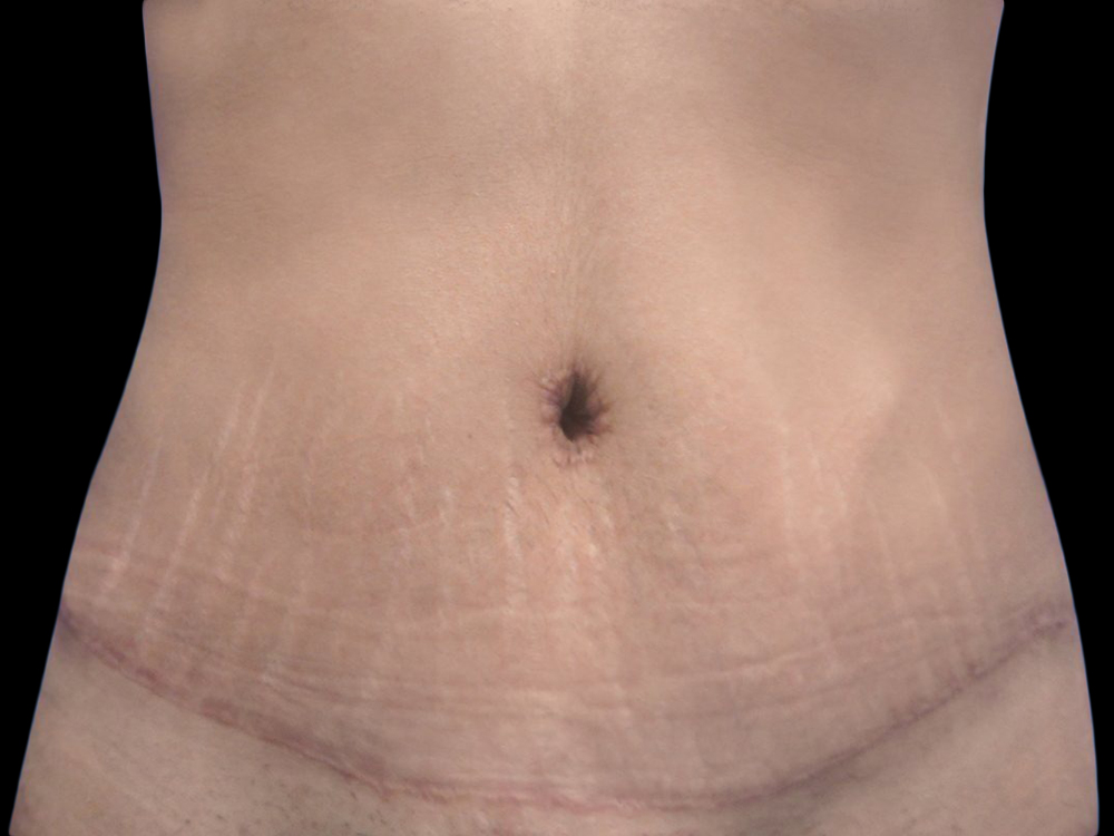 Case--21243 | After Tummy Tuck