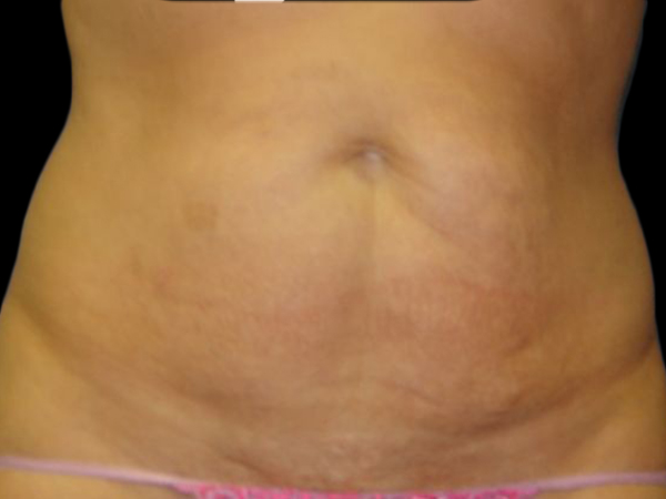 Case--21246 | Before Tummy Tuck