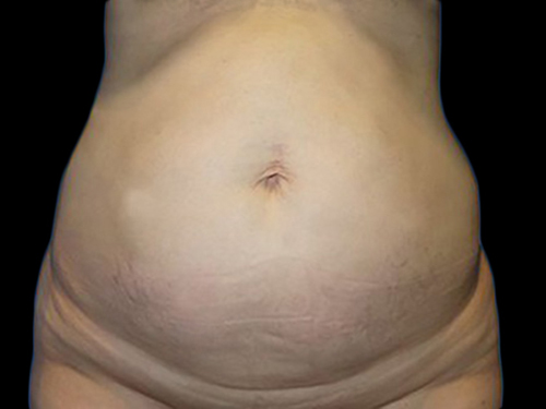 Case--21255 | Before Tummy Tuck