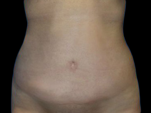 Case--21255 | After Tummy Tuck