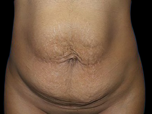 Case--21248 | Before Tummy Tuck