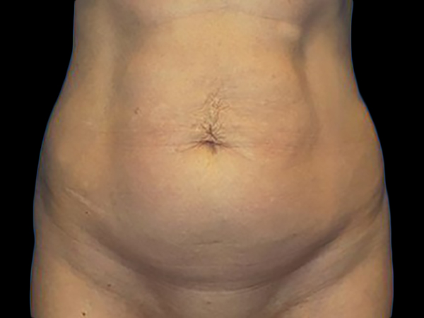 Case--21251 | Before Tummy Tuck