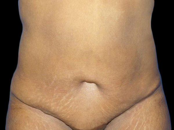 Case--21252 | Before Tummy Tuck