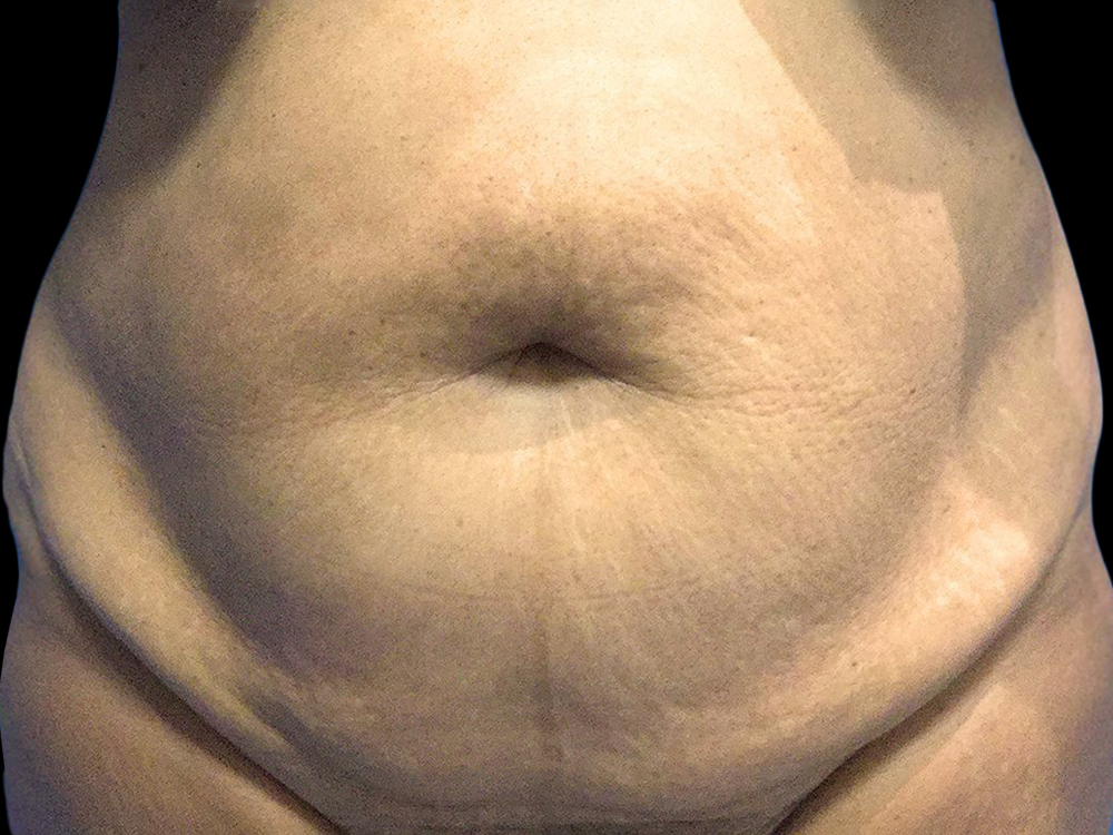 Case--21254 | Before Tummy Tuck