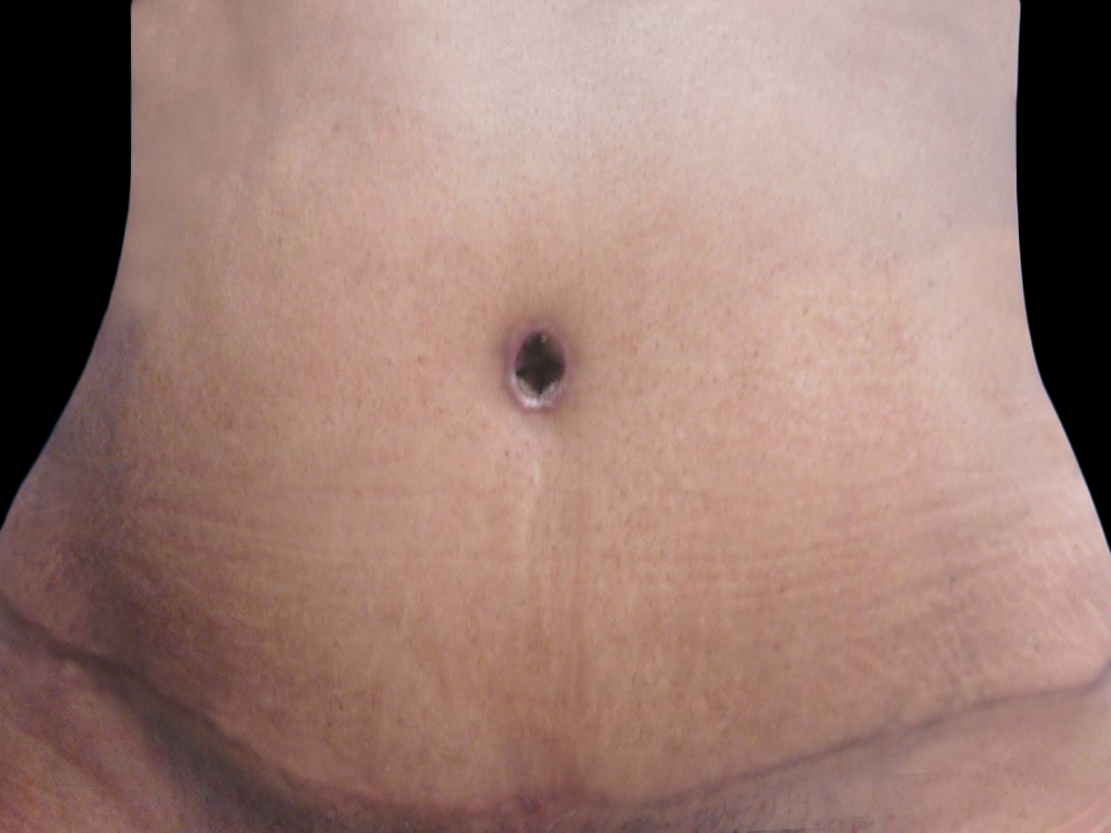 Case--21254 | After Tummy Tuck