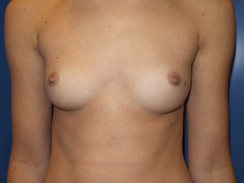 Case--1397 | Before Breast Augmentation