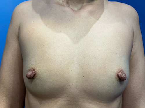 Case--2926 | Before Breast Augmentation