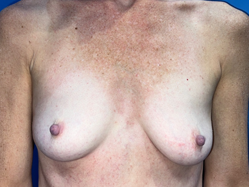 Case--1236 | Before Breast Augmentation