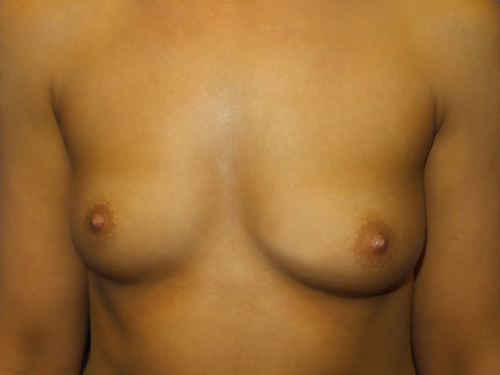 Case--20855 | Before Breast