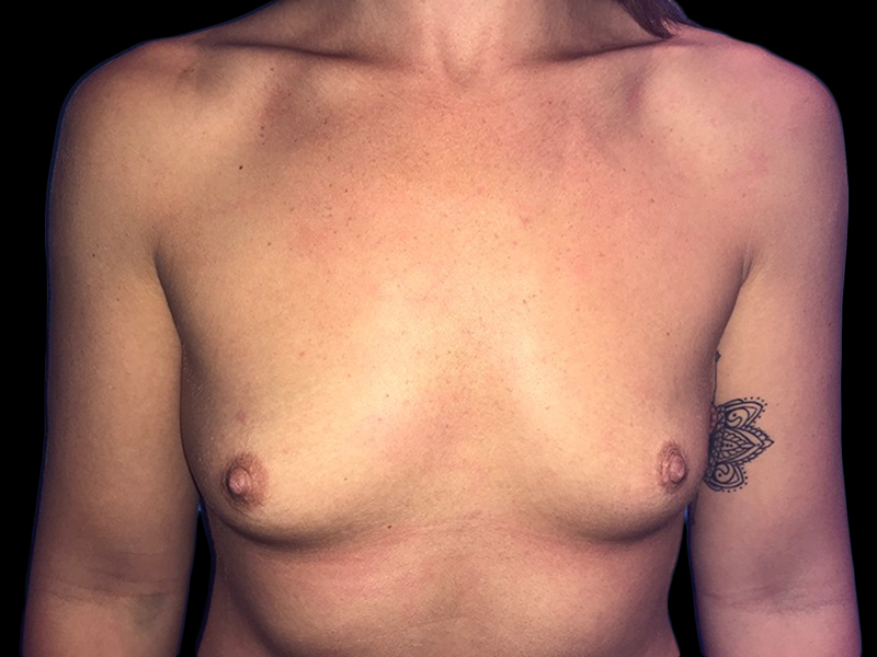 Case--20857 | Before Breast