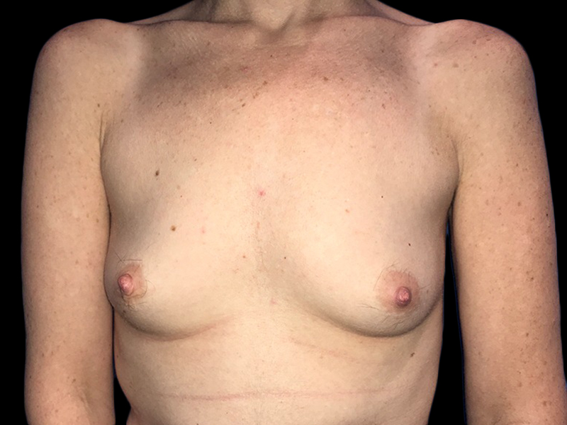 Case--20859 | Before Breast