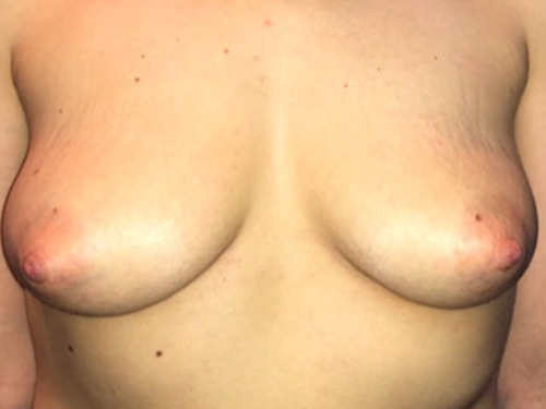 Case--20876 | Before Breast