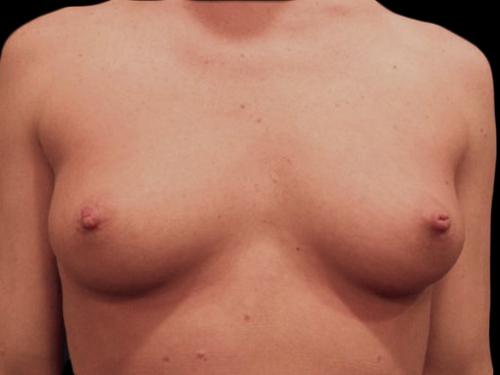Case--20861 | Before Breast