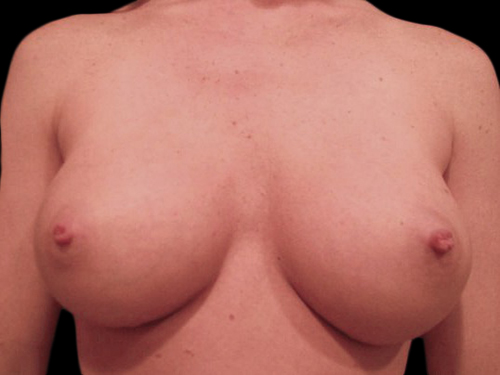 Case--20861 | After Breast