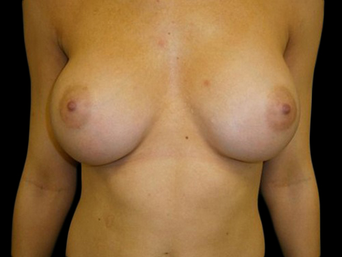 Breast Augmentation Before and After 11b