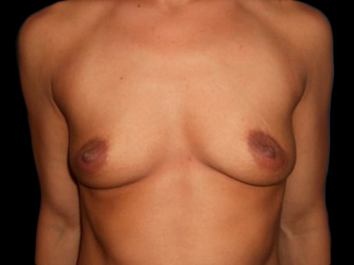 Case--20864 | Before Breast