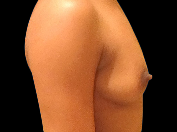 Case--20869 | Before Breast