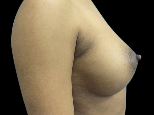 Case--20869 | After Breast