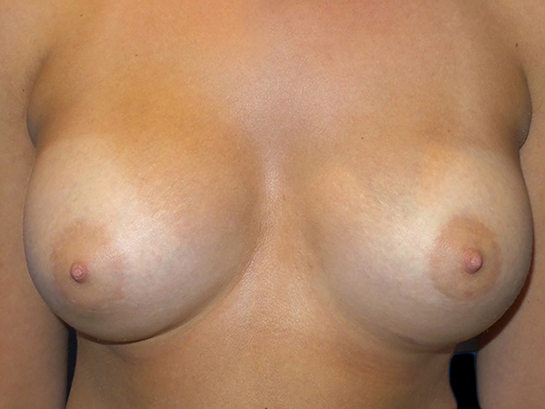 Case--20870 | After Breast