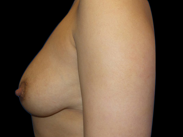 Case--20871 | Before Breast