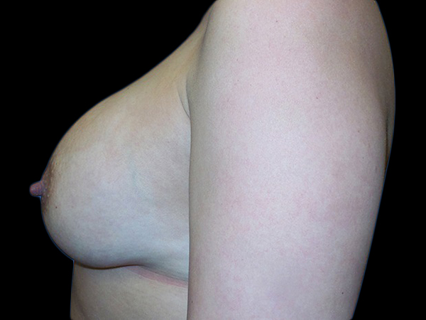 Case--20871 | After Breast