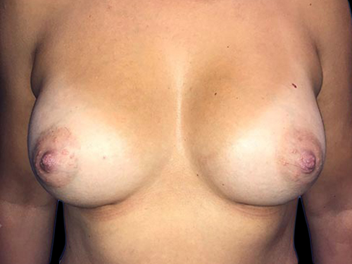 Case--20889 | After Breast Augmentation