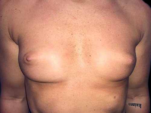 Case--20893 | Before Breast Augmentation