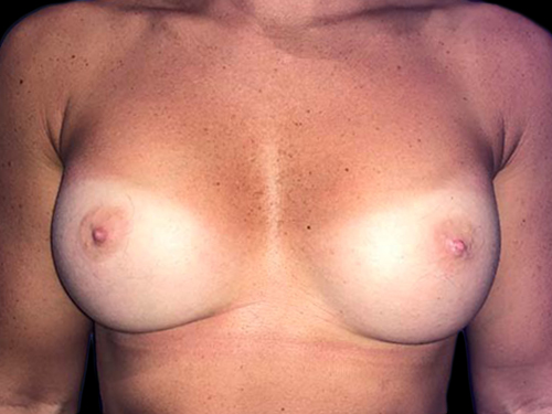 Case--20893 | After Breast Augmentation