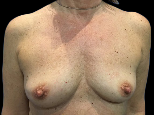 Case--20894 | Before Breast Augmentation