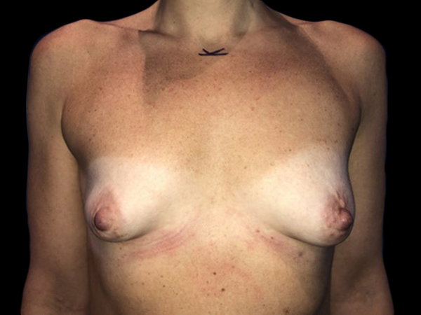 Case--20896 | Before Breast Augmentation