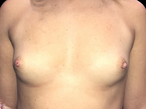 Case--20900 | Before Breast Augmentation