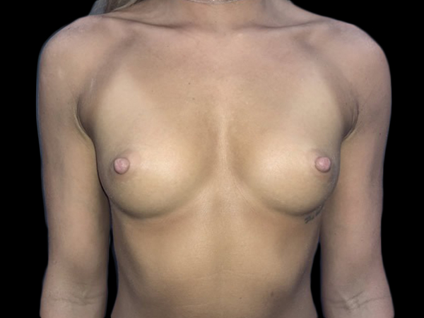 Case--20902 | Before Breast Augmentation