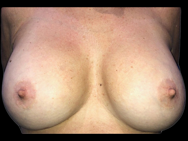 Case--21327 | After Breast Augmentation