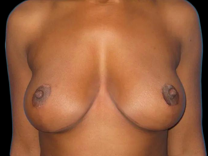 Before and After Breast Lift Photo Gallery Case 04b