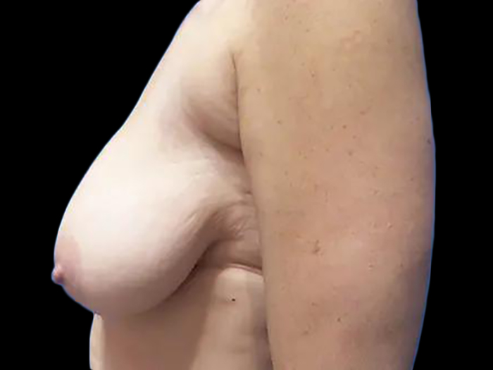 Before and After Breast Lift Photo Gallery Case 09a