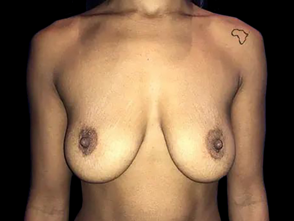 Case--21011 | Before Breast Lift
