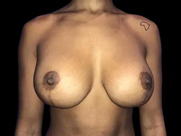 Case--21011 | After Breast Lift