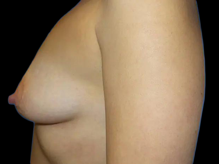 Case--21016 | Before Breast Lift
