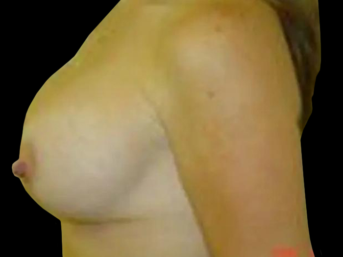 Case--21016 | After Breast Lift