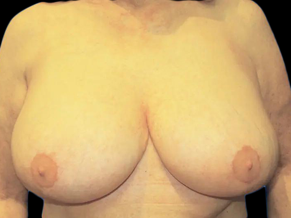 Case--21019 | After Breast Lift