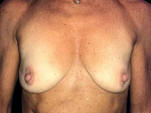 Case--21023 | Before Breast Lift