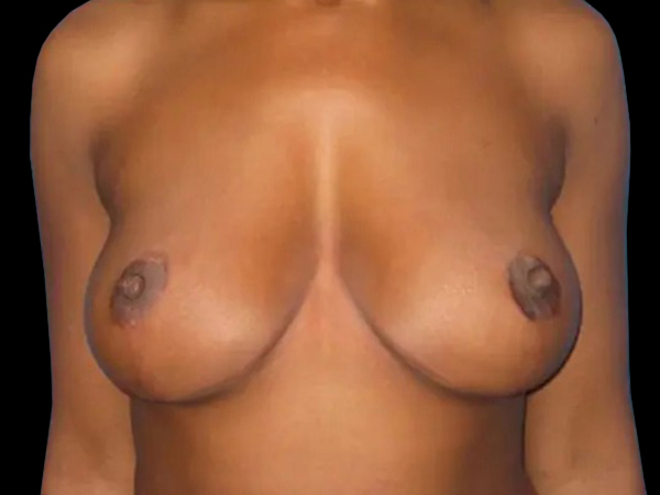 Case--21042 | After Breast Reduction