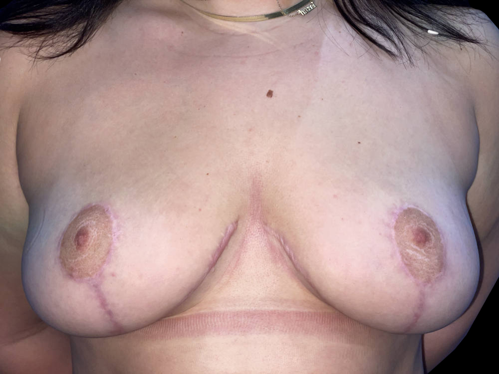 Case--19205 | After Breast Reduction