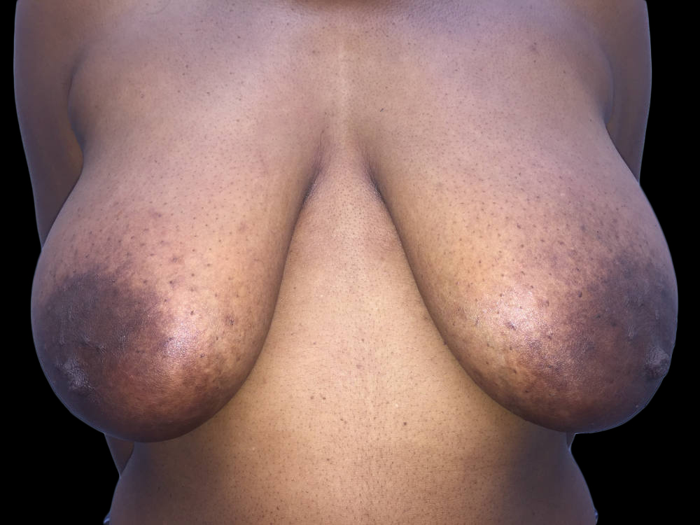 Case--19207 | Before Breast Reduction